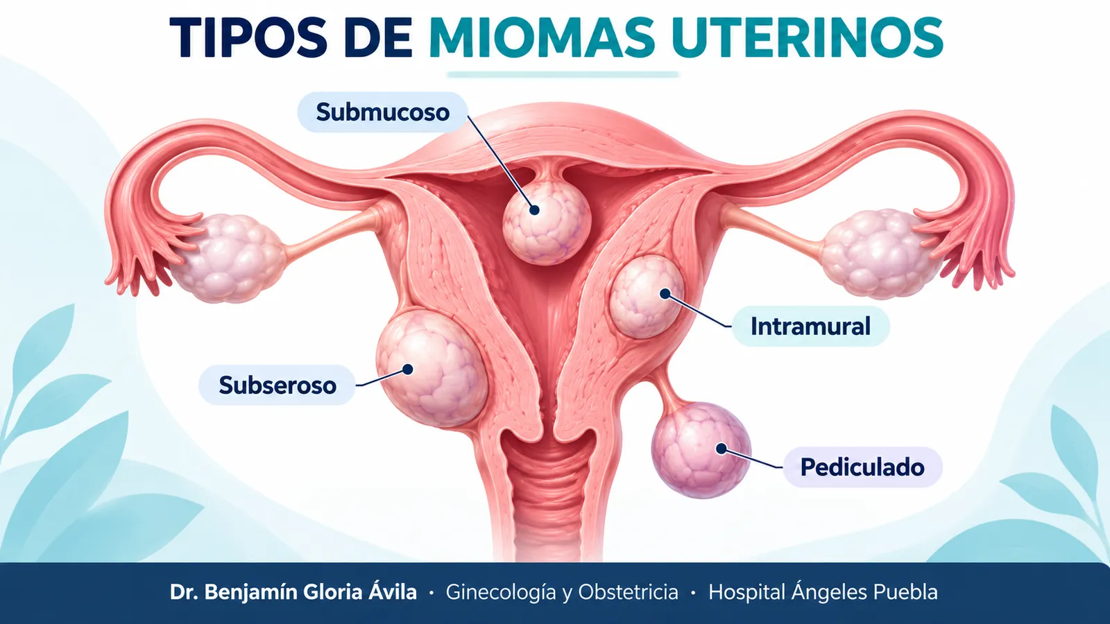 Tipos de miomas uterinos tipos miomas uterinos diagnostico tratamiento puebla
